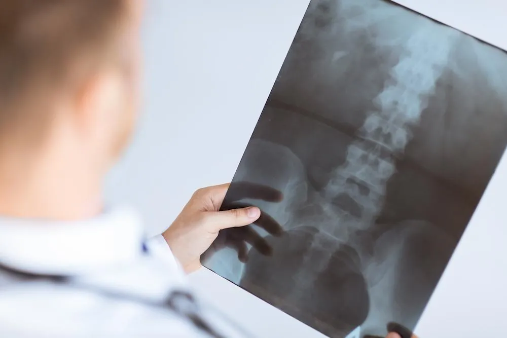 Doctor in a white coat holding up a lower spine X-ray film