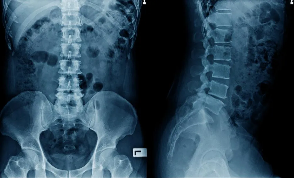 Front and side X-ray views of the lower spine and pelvis
