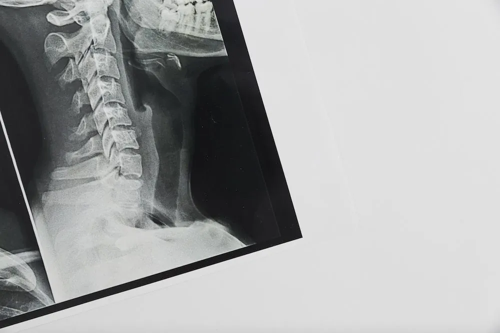 Side-view X-ray film of the neck vertebrae on a white surface